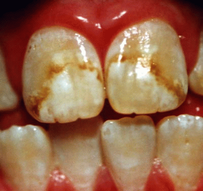 Fluorosis present in 41% of US teenagers, From ImagesAttr