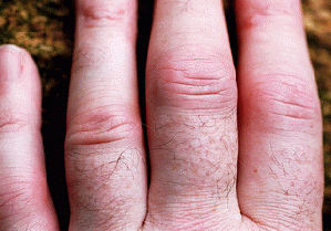 Rheumatoid Arthritis Fingers, From ImagesAttr