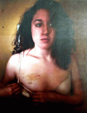 Cecily McMillan shows breast injury where NY cop grabbed her during arrest (, From ImagesAttr