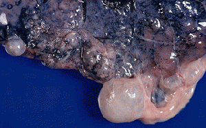 Emphysema, bullous, subpleural