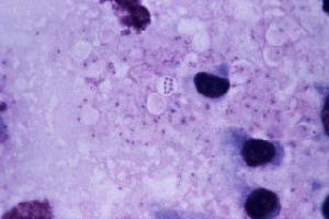 Anthrax infection, From ImagesAttr