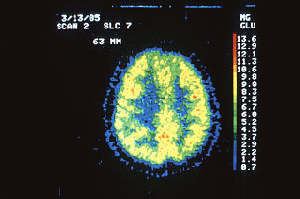 PET scan of a normal brain, From ImagesAttr