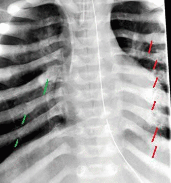 Fractures of ribs in an infant., From ImagesAttr