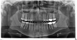 X10068 - panorex - Dentist Visit Teeth x-ray, From ImagesAttr