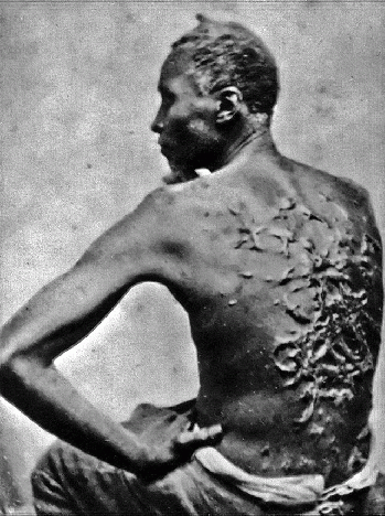 A photograph showing the whipping scars on the back of an African-American slave., From WikimediaPhotos