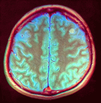 Brain MRI 143937 rgbcb ce, From WikimediaPhotos