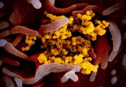 SARS-CoV-2 (yellow) among human cells (pink) This virus was isolated from a patient in the U.S.