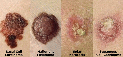 Figure 2. Types of skin cancer, where my 1/2-inch -wide cancer was non-mlaignant but looked like the malignant melanoma., From Uploaded