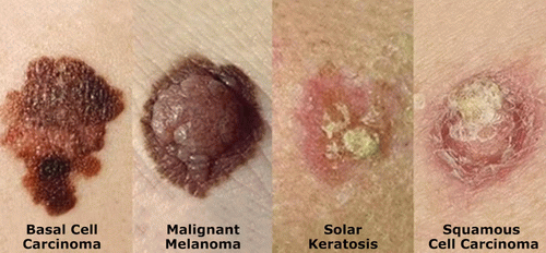 Figure 11. X-rays cause skin cancer like the cancers shown here ('X-rays, Cancer, and a U.S. Medical and Dental Industry Cover-up Equal No Patients' Rights').