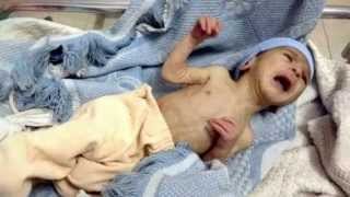 Syrian Children are Starving to Death Syrian Children are Starving to Death